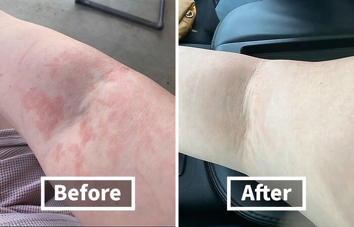 Rashes Got You Feeling Like You're Auditioning For A Horror Movie? This Fast Acting Rash Cream Will Soothe That Itchy Skin And Have You Feeling Comfortable In Your Own Skin Again 