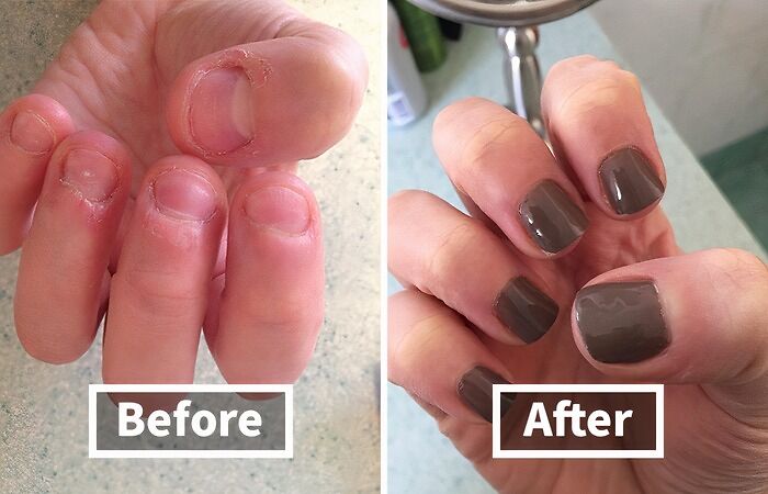 Nail-Biting Habit Got Your Fingers Looking Like They Lost A Fight With A Cheese Grater? This Nail Care Treatment Will Help You Kick That Habit To The Curb