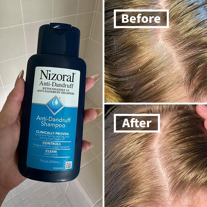 Snow On Your Shoulders, But It's Not Christmas? This Nizoral Anti-Dandruff Shampoo Will Have You Flake-Free And Feeling Festive All Year Round