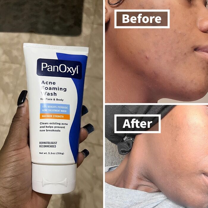 This Panoxyl Acne Foaming Wash Is Like A Superhero For Your Skin, Battling Breakouts And Leaving Your Complexion Clearer Than A Crystal Ball