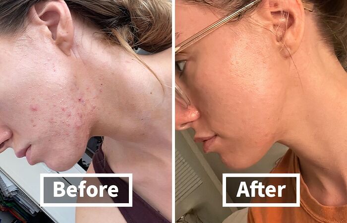 Zap Those Zits Into Oblivion! This Acne Treatment Gel Is The Spot Treatment That Will Banish Blemishes And Have Your Skin Looking Clearer Than A Freshly Cleaned Mirror