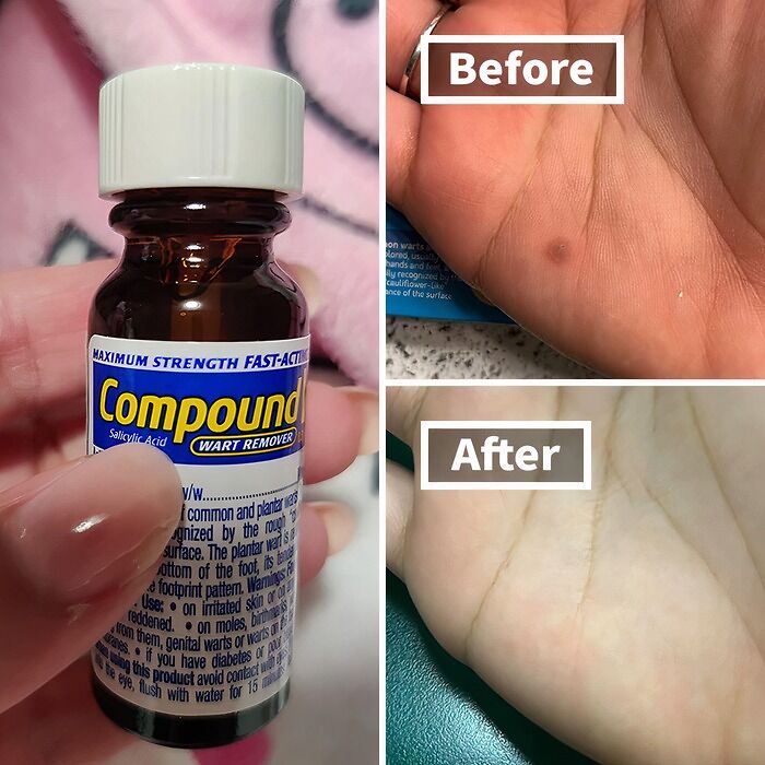 Warts Cramping Your Style? This liquid Wart Remover Will Banish Those Pesky Bumps And Have You Feeling Confident In Your Own Skin Again