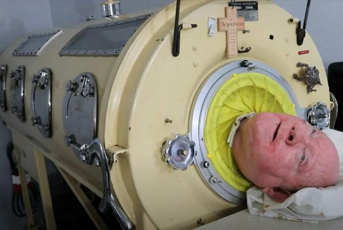 Paul Alexander Is The Last Person Living In An Iron Lung After He Contracted Polio In 1952 At The Age Of Six