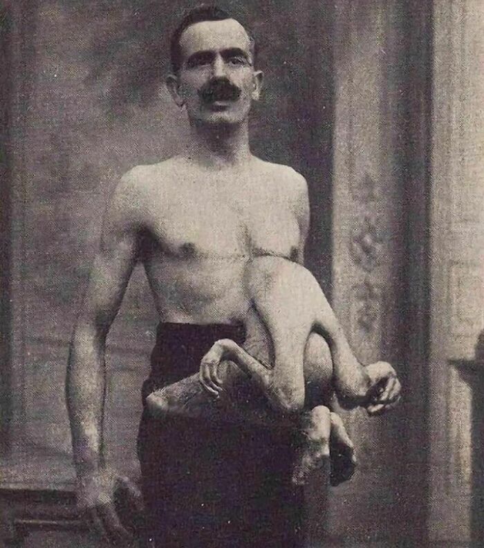 In The Early 20th Century, Jean Libbera, Also Referred To As The "Double-Bodied Man," Was A Sideshow Performer Alongside His Parasitic Twin, Jacques