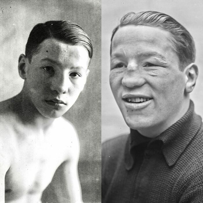 Boxer Fred Bretonnel In 1920 At The Age Of 15 And In 1928 At The Age Of 23