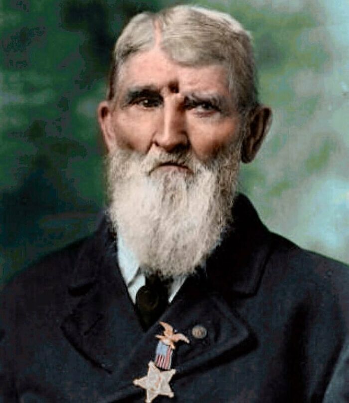 American Civil War Veteran Jacob Miller, Photographed In 1911, With A Bullet Hole In His Head That He Obtained During The Battle Of Chickamauga Whilst Fighting For The Union Army In 1863