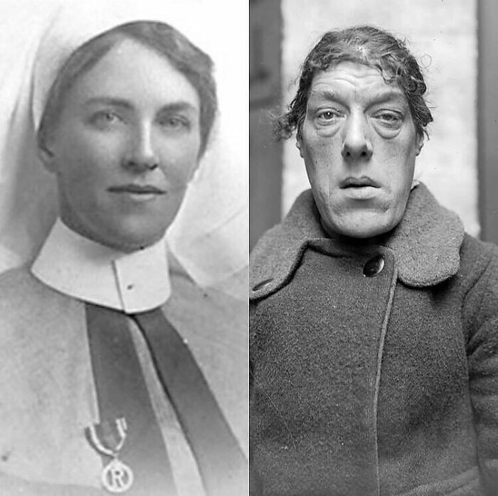 Mary Ann Bevan (1874 - 1933) Was An English Woman Who Toured The Sideshow Circuit As “The Ugliest Woman In The World” After Her Appearance Drastically Changed Due To Developing Acromegaly