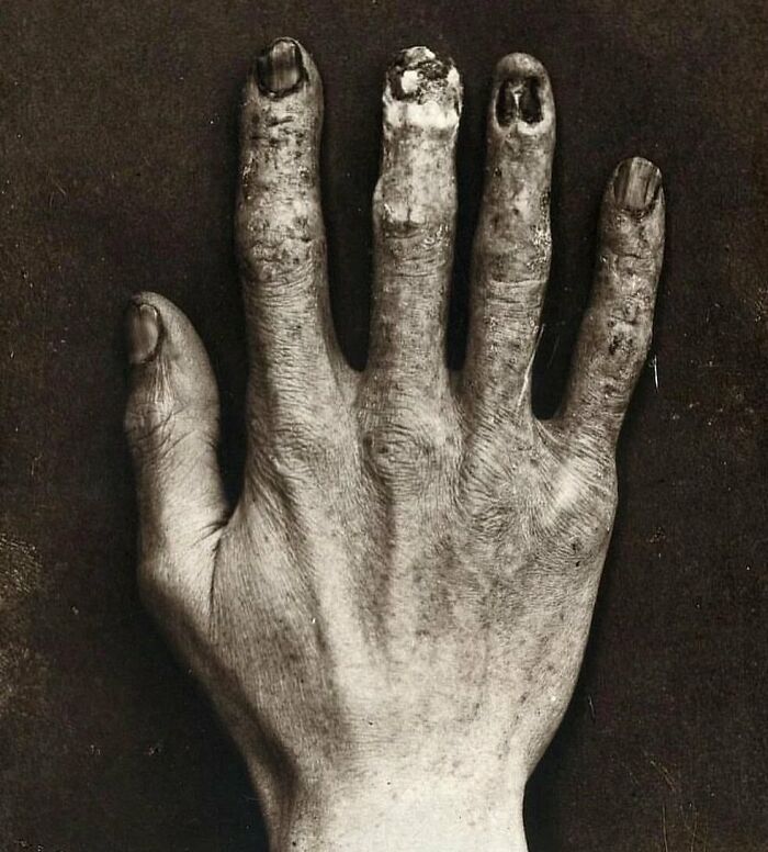 Mano de un técnico de rayos X del Hospital Real de Londres, que muestra los daños causados por la exposición a la radiación, 1900