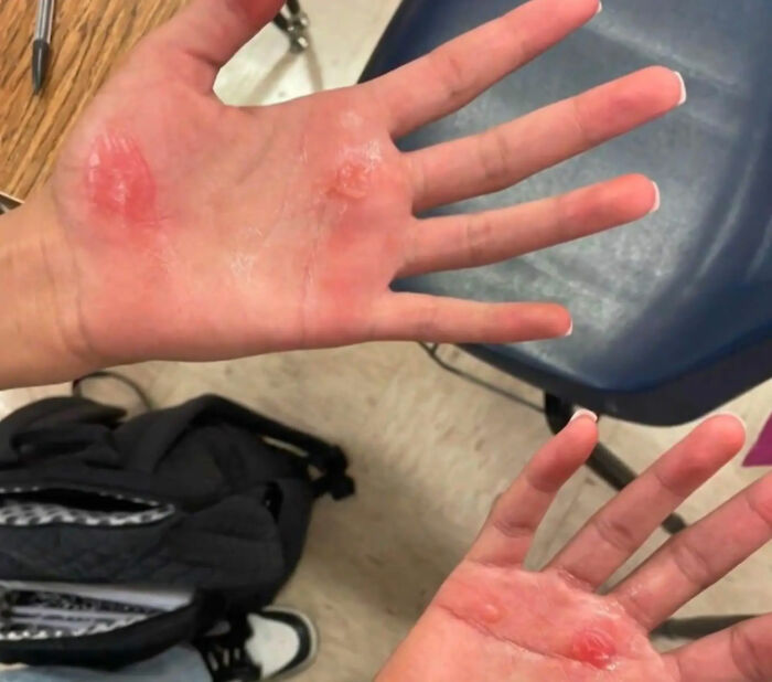 Outrage Erupts As Texas Cheerleaders Suffer Burns From Coach’s “Barbaric” Punishment