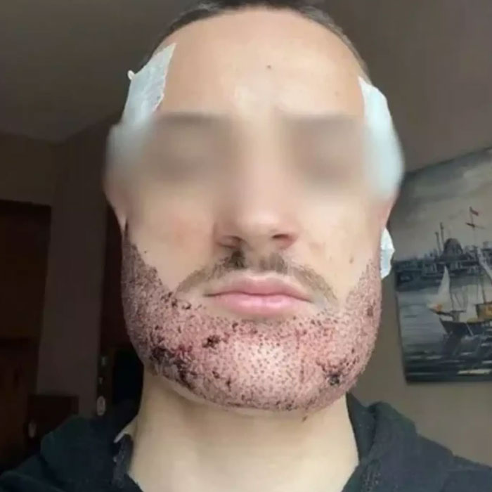 Man Takes His Own Life After Real Estate Agent Poses As Surgeon And Performs Beard Transplant