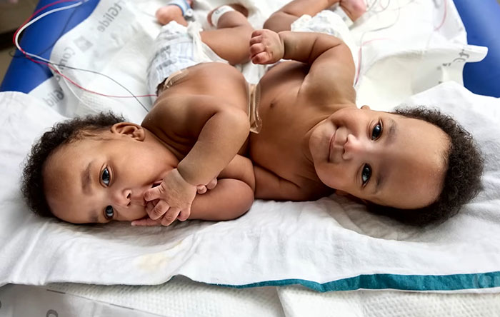 "So Grateful": Mom Of Successfully Separated Conjoined Twins Reveals They Went Home After A Year