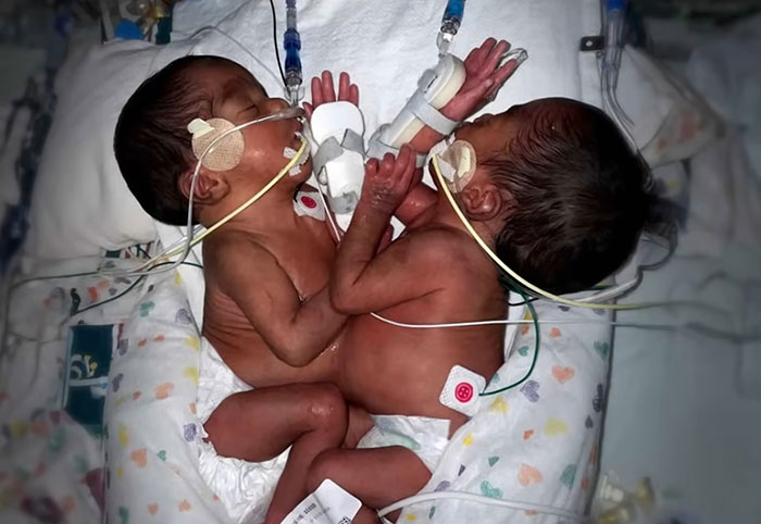 "So Grateful": Mom Of Successfully Separated Conjoined Twins Reveals They Went Home After A Year