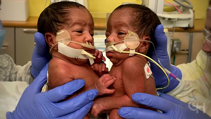 "So Grateful": Mom Of Successfully Separated Conjoined Twins Reveals They Went Home After A Year