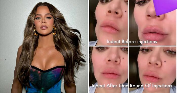 Khloé Kardashian Shares Before-and-After Pics of Facial Injections After Removing Tumor From Cheek