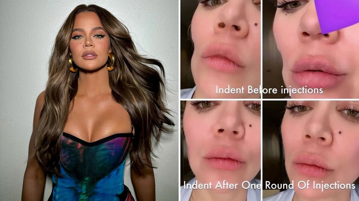 Khloé Kardashian Shares Before-and-After Pics of Facial Injections After Removing Tumor From Cheek