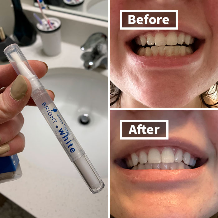 A Painless Path To A Perfect Smile: Countless Reviewers Are Thanking Their Lucky Stars For Discovering The Venus Visage Teeth Whitening Pen 