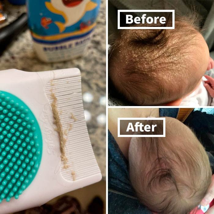 Gently Remove Flakes And Soothe Scalp Irritation With Cradle Cap Brush And Comb, A Gentle And Effective Solution For Cradle Cap Relief