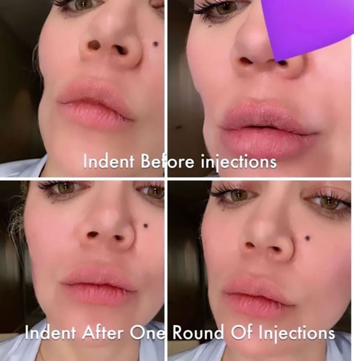 Khloé Kardashian Shares Before-and-After Pics of Facial Injections After Removing Tumor From Cheek