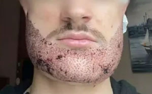 Man Takes His Own Life After Real Estate Agent Poses As Surgeon And Performs Beard Transplant