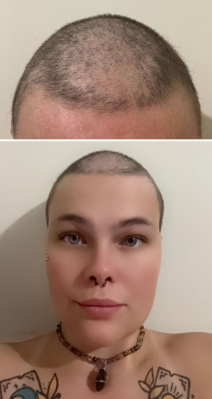 Decided To Shave My Head To Give It A Fresh Start, Turns Out I Have A Bald Spot. I’m Female