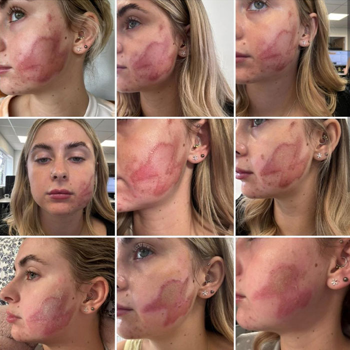 "Horrific": Woman Suffers Second-Degree Burns After Getting Popular Beauty Procedure