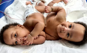 “So Grateful”: Mom Of Successfully Separated Conjoined Twins Reveals They Went Home After A Year