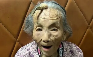 “It’s Too Risky”: 107YO Goes Viral For 4-Inch “Longevity Horn” Growing From Her Forehead