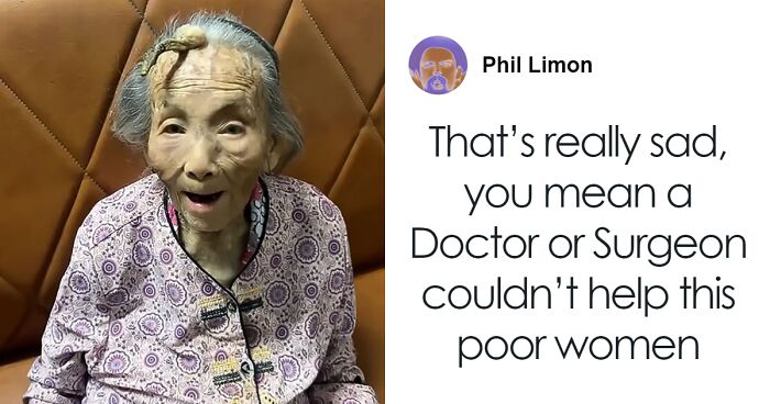 Social Media Erupts Over 107-Year-Old Woman’s Massive 4-Inch Forehead “Horn”