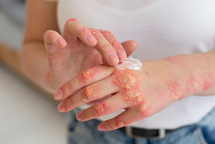 Woman Suspects Hubby Turned On Soft Water To “Test” Her Eczema, Worries About Her Marriage