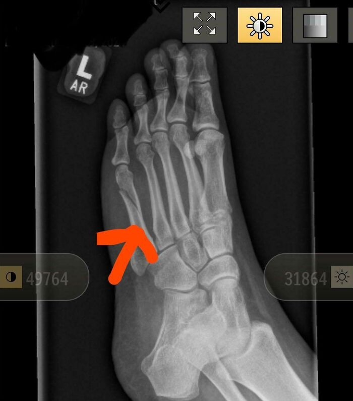 Broke My Foot With A Week Left On My Vacation