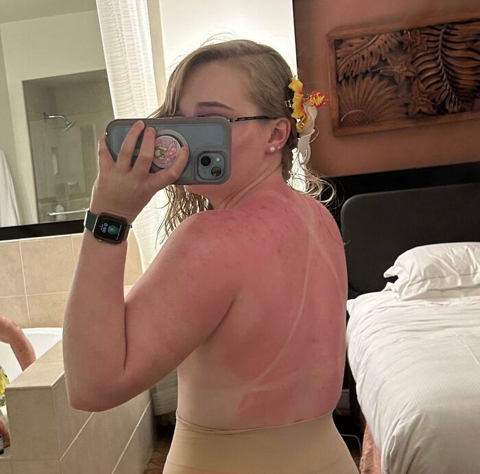 I Recently Went To Hawaii And Got A Gnarly Sunburn As Seen Here. Ended Up Getting A Case Of “Hell’s Itch”, Which Was Genuinely The Worst Pain I’ve Ever Experienced, And That’s Saying A Lot