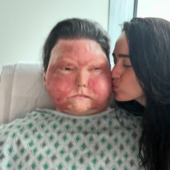 Man Who Had World’s First Face And Hands Transplant Shares Engagement Photos With Fiancée