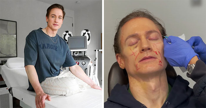 Billionaire Trying To Reverse Aging Injected Fat Into His Face—Reveals “Disturbing” Results