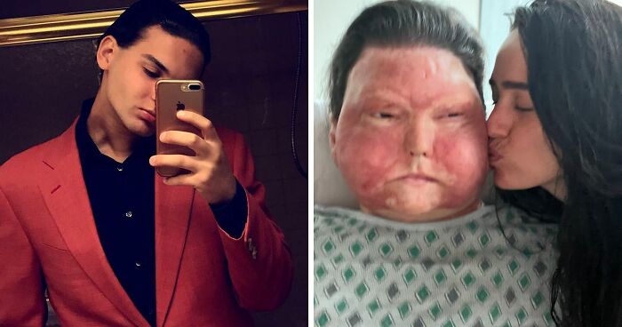 Man Who Had World’s First Face And Hands Transplant Shares Engagement Photos With Fiancée