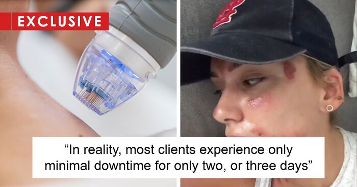 TikToker Suffers Chemical Facial Burns After Undergoing Microneedling, Esthetician Speaks Out