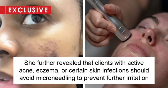 Amid Viral Injuries, Skin Expert Exposes Dangers Of Botched Microneedling Treatments (Exclusive)