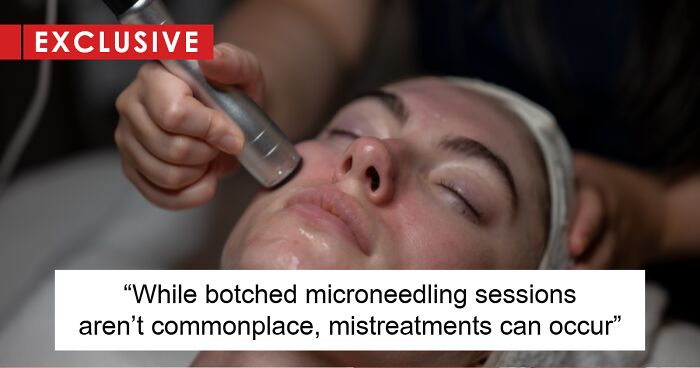 Amid Viral Injuries, Skin Expert Exposes Dangers Of Botched Microneedling Treatments (Exclusive)