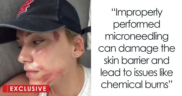 TikToker Suffers Chemical Facial Burns After Microneedling, Esthetician Shares Safe Practices