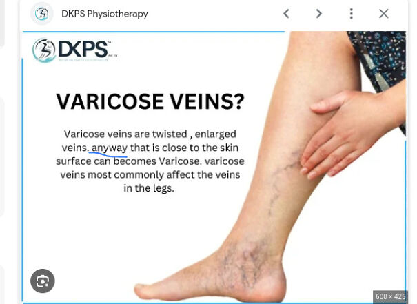 Found This While Looking Up What Vericose Veins Were. Should Have Been "Any Vein"