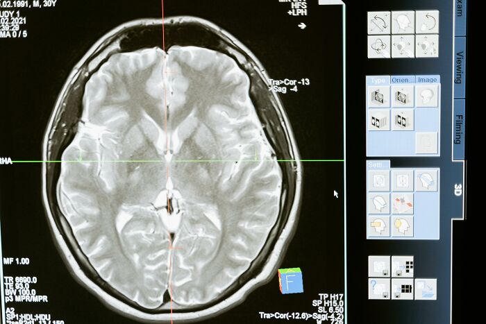 MRI brain scan showing potential body alterations on a medical display screen.