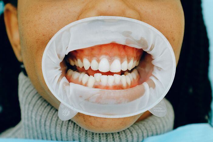 Close-up of a person with a dental retractor, illustrating altered teeth.