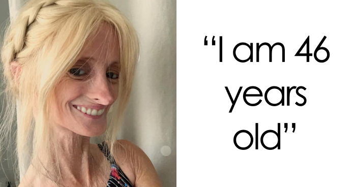 “Right Now Is All We Have”: Woman With Rare ‘Benjamin Button’ Condition Claps Back At Trolls