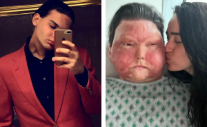 Man Who Had World’s First Face And Hands Transplant Shares Engagement Photos With Fiancée