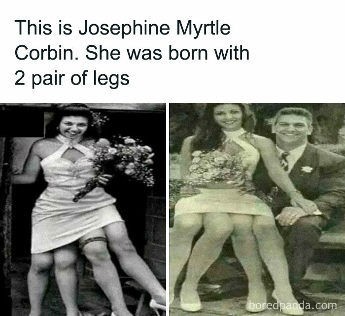 Two black and white photos of Josephine Myrtle Corbin, known for having two pairs of legs, showcasing an undiscovered fact.