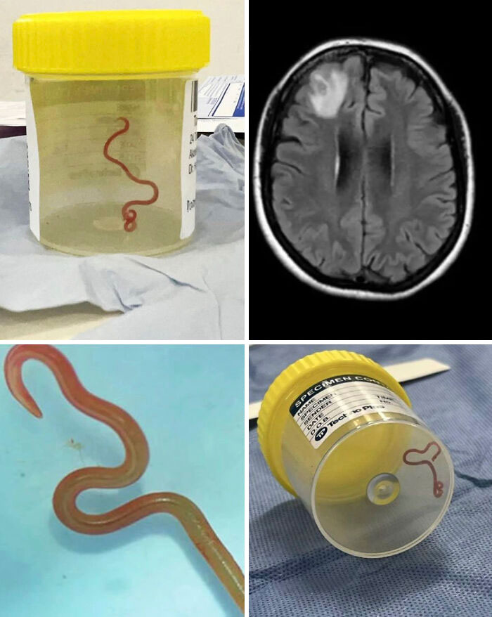 Medical case: Brain MRI and specimen jar with worm, highlighting human body resilience.