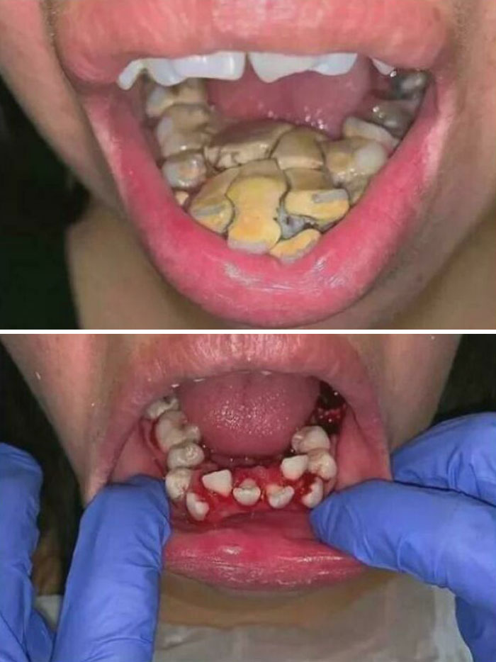 Unusual dental case showcasing severe plaque buildup and gingival treatment, highlighting the complexity of the human body.