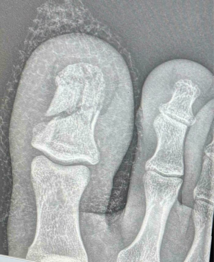 X-ray showing foot fractures, depicting Christmas accidents.