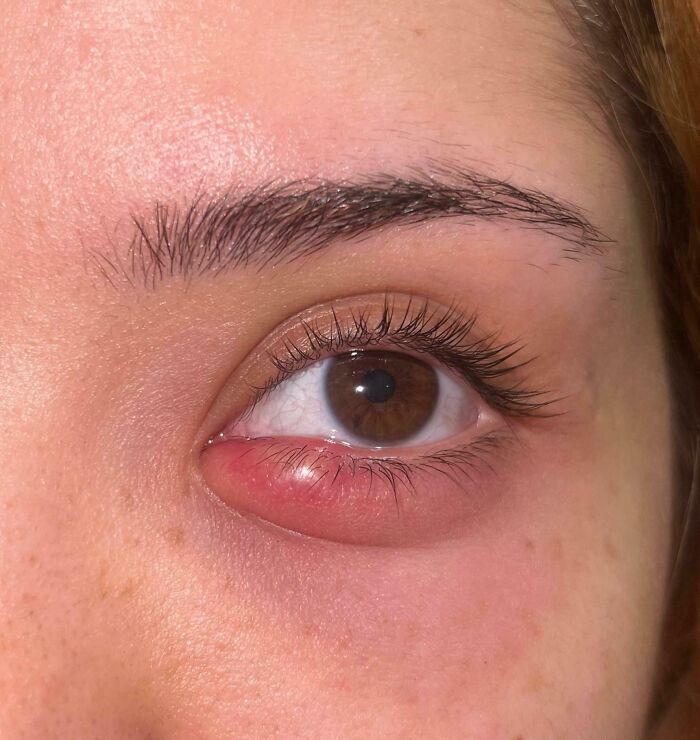 Close-up of an eye with a red, swollen lower eyelid, possibly indicating a Christmas accident.