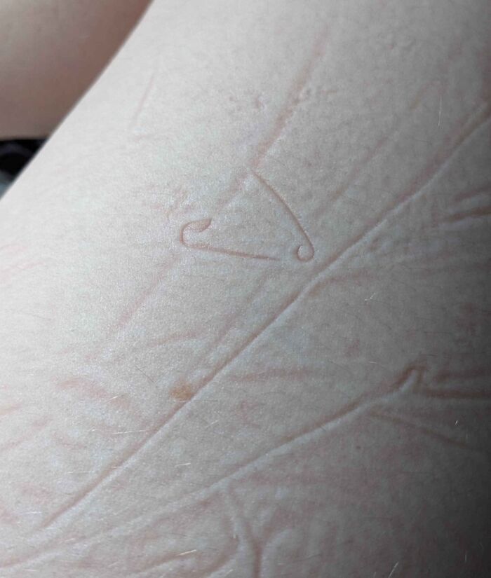 Skin with an imprint of a safety pin shape, showcasing a mildly interesting pattern.