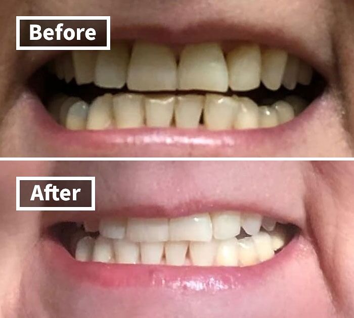 "Teeth whitening before and after, a top Amazon buy this year."